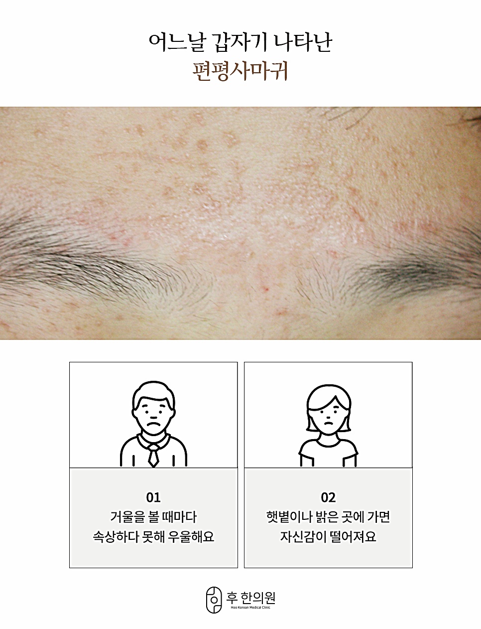 피부색 혹은 옅은 갈색을 띠며 나타나는 편평사마귀