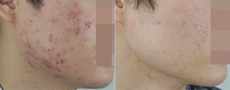 신림 피부과 성인여드름 치료 전후 비교 사진, 볼 라인 화농성 병변 개선 사례