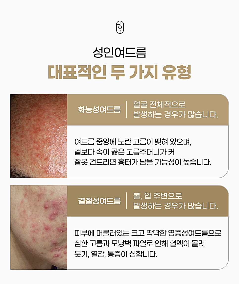 성인여드름 대표적인 두 가지 유형, 화농성여드름과 결절성여드름 비교 안내