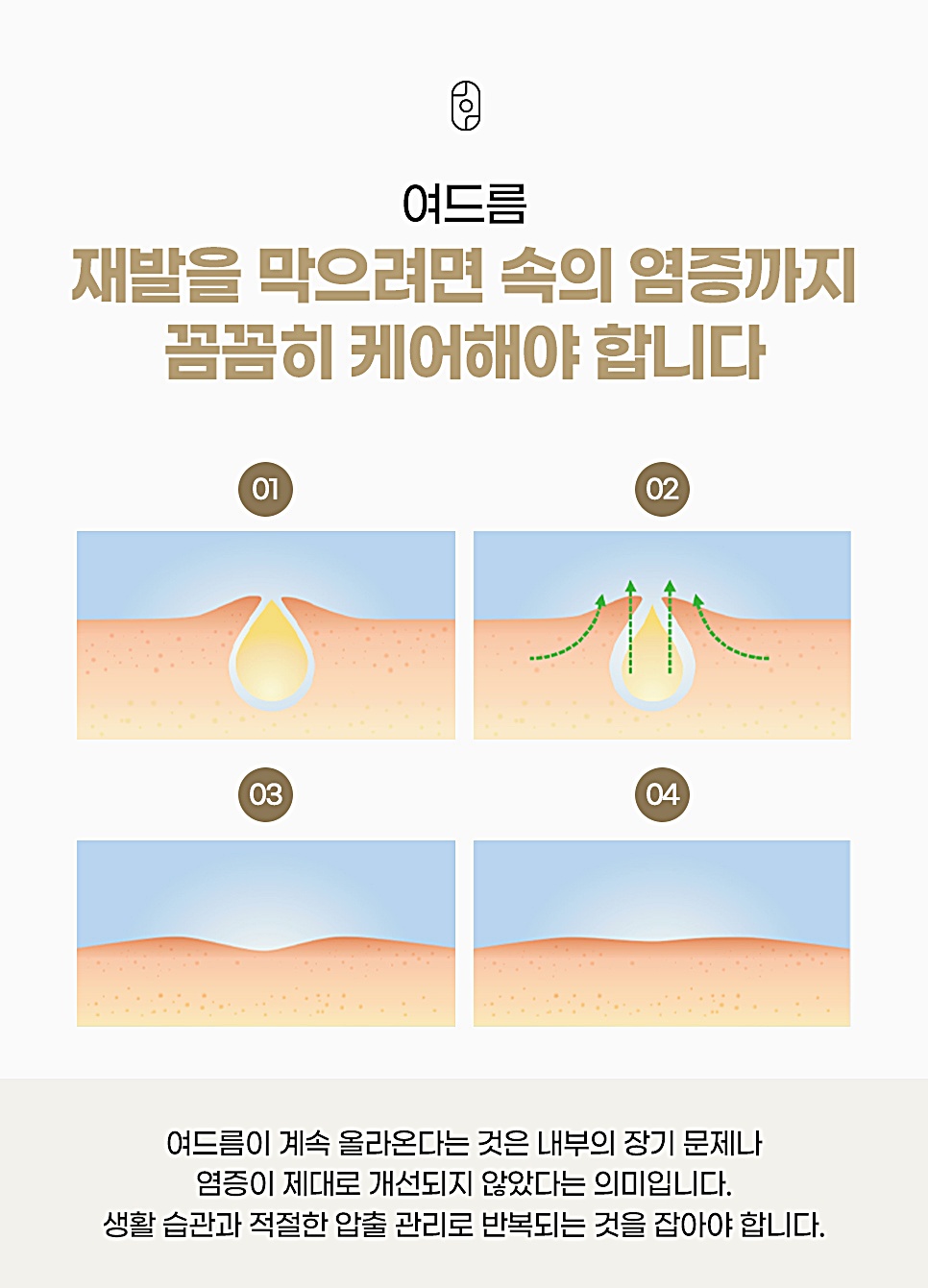 여드름 재발 방지를 위한 4단계 속 염증 관리 과정 안내 카드