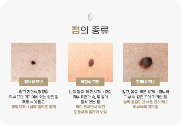 신림돌출점제거 점 종류별 깊이 비교 도식