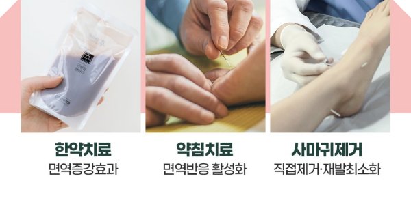신림편평사마귀제거 치료방법
