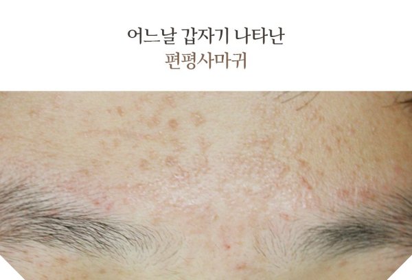 신림편평사마귀 사진
