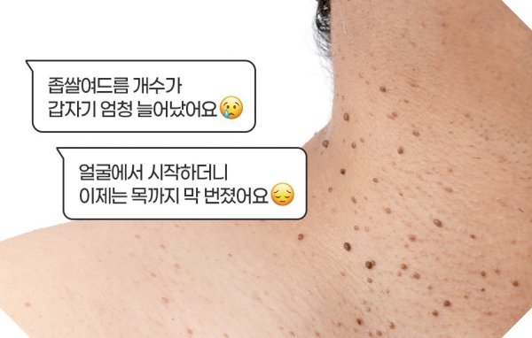 신림편평사마귀제거 고민