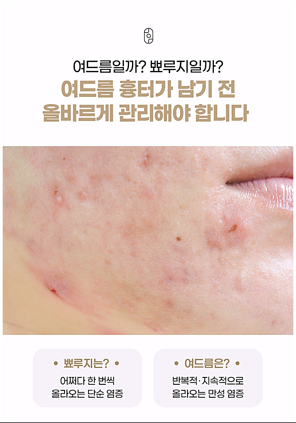 신림 여드름한의원 여드름일까 뾰루지일까, 여드름 흉터가 남기 전 올바르게 관리해야 하는 이유
