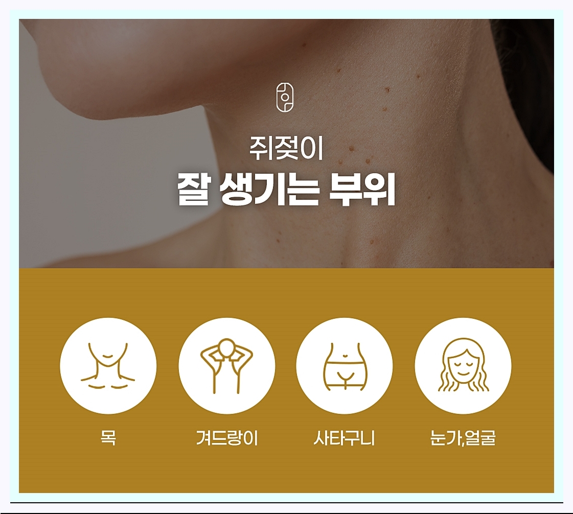 쥐젖이 주로 발생하는 부위에 대한 설명 이미지