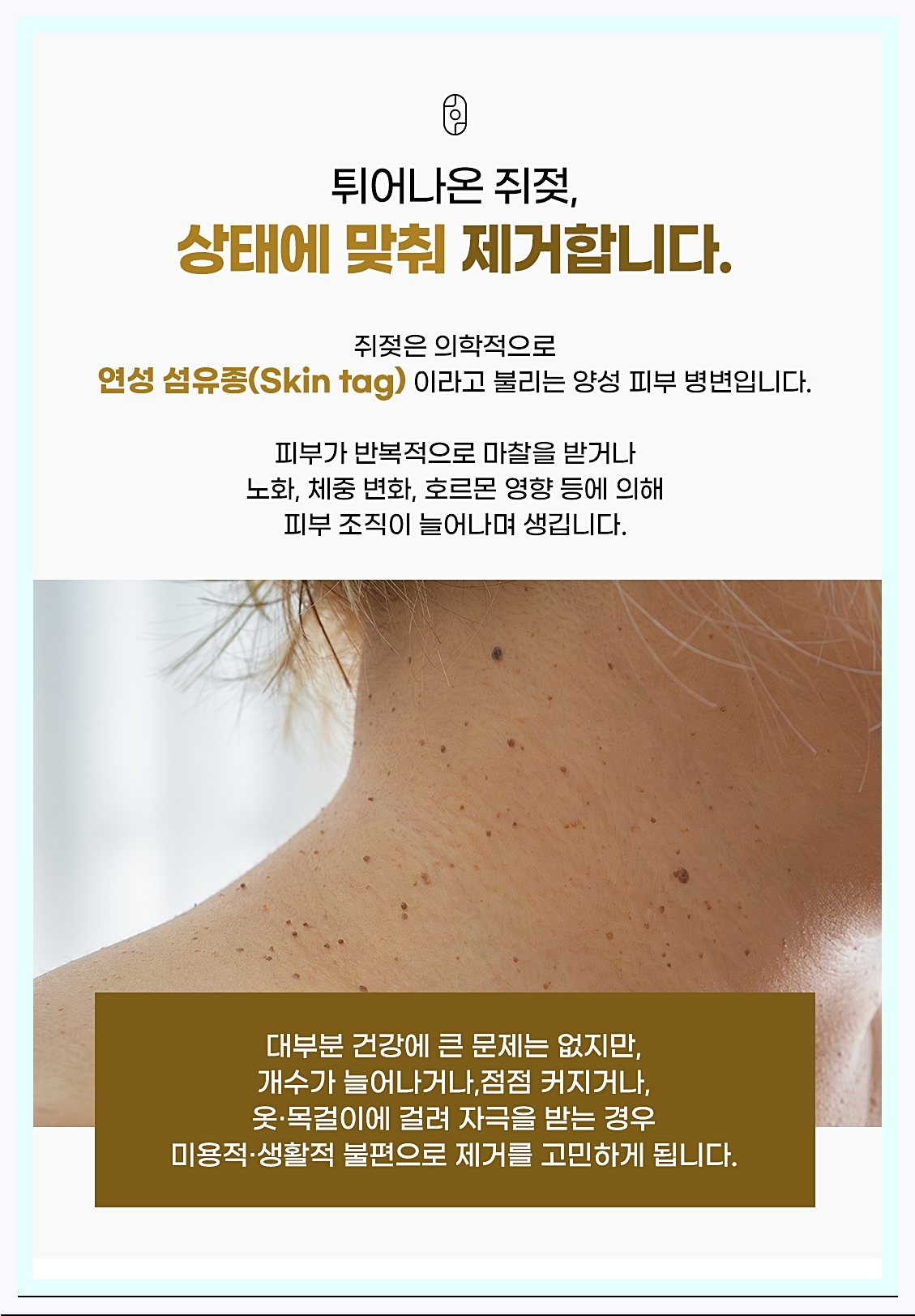쥐젖의 상태에 맞춘 제거 설명