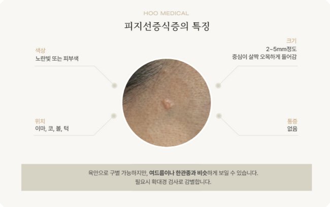 신림피지선증식증의 특징 - 크기 2-5mm, 중앙 함몰, 노란빛 색상, 통증 없음