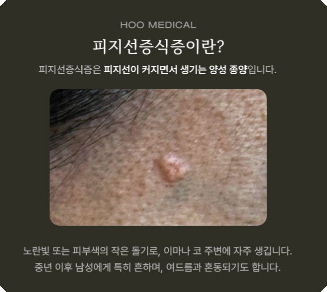 신림피지선증식증 증상 - 얼굴 피부 확대 이미지