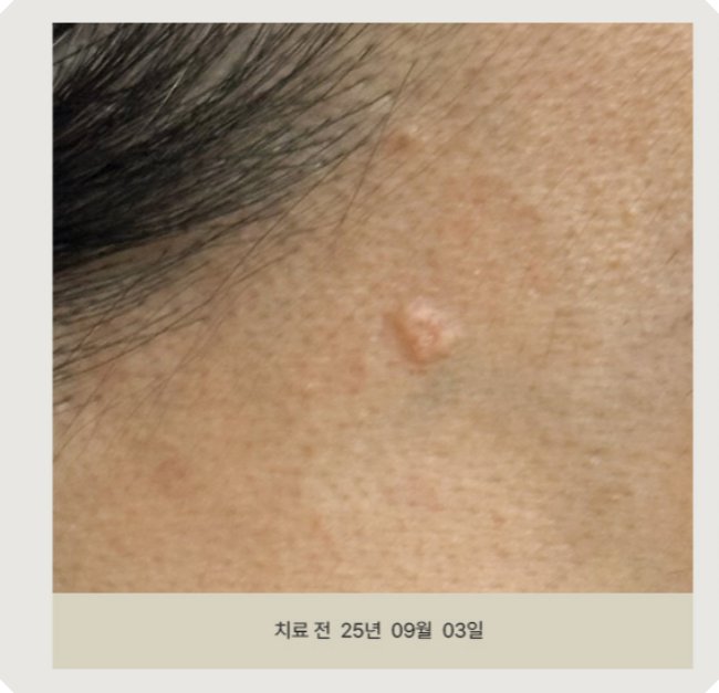 신림피지선증식증 시술 전 - 얼굴의 돌출된 피지선 병변 확인