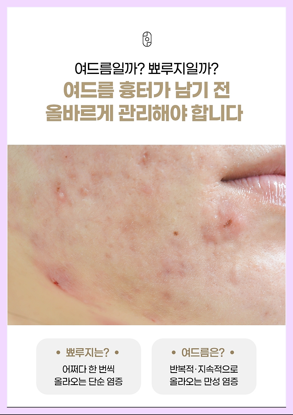 서울대입구피부과 여드름의 정의 설명