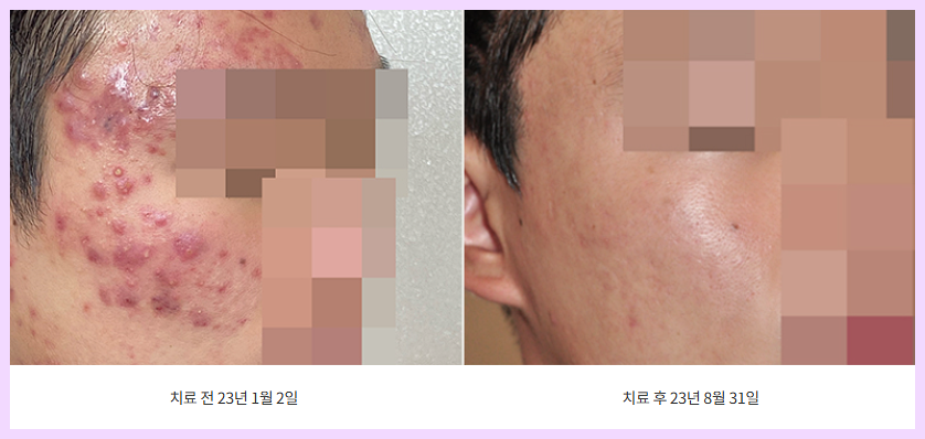 얼굴 화농성 치료 전후