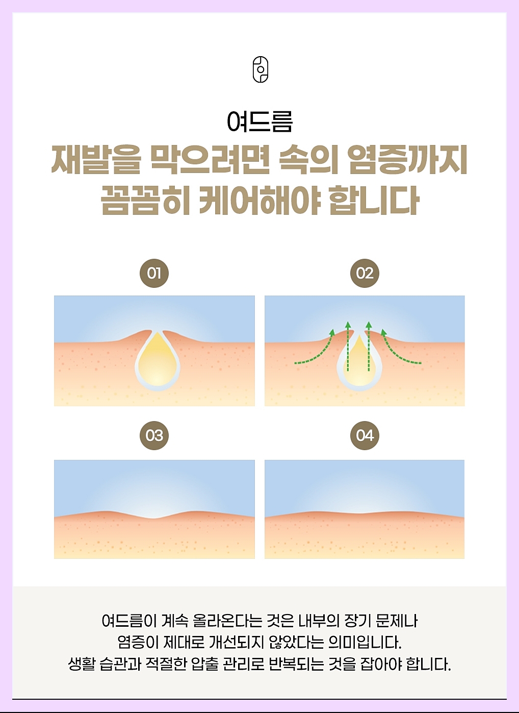 서울대입구피부과 재발을 막는 포인트