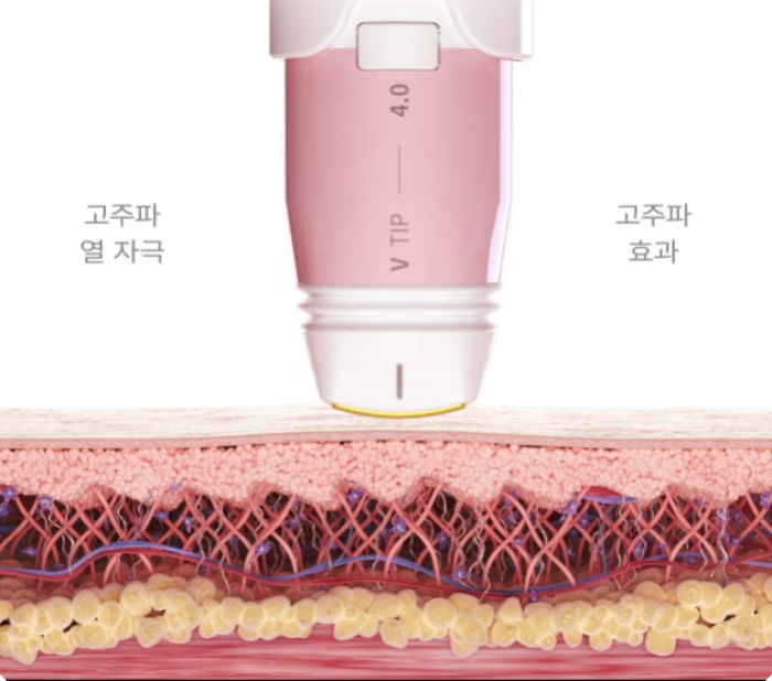 신림 볼뉴머가 피부에 작용하는 원리 - 고주파 열 자극으로 진피층의 콜라겐과 엘라스틴이 응고·수축·재생되는 3단계 과정 설명도