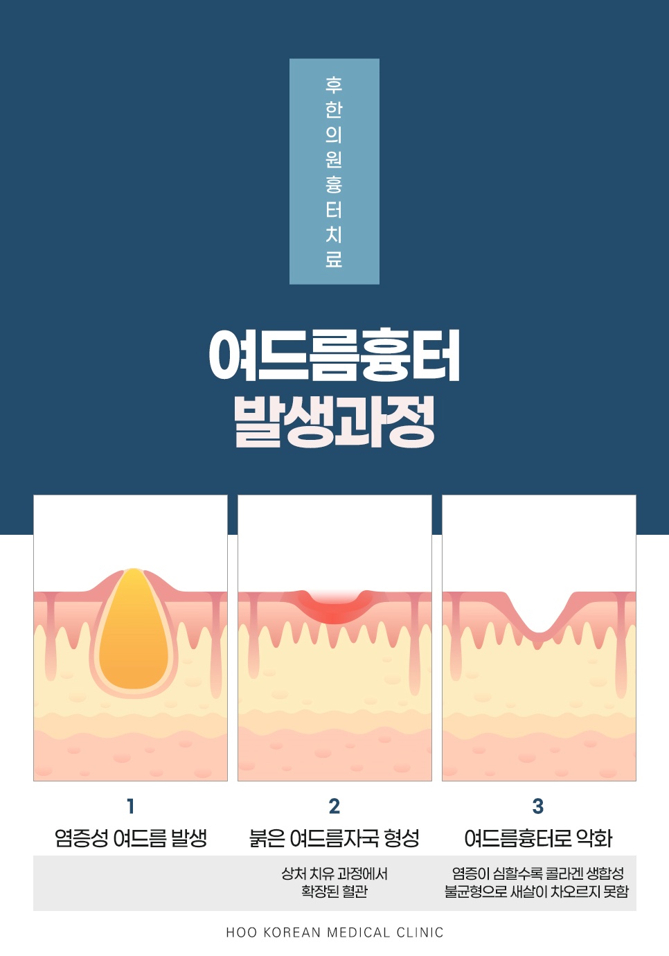 여드름 흉터 발생 과정 안내