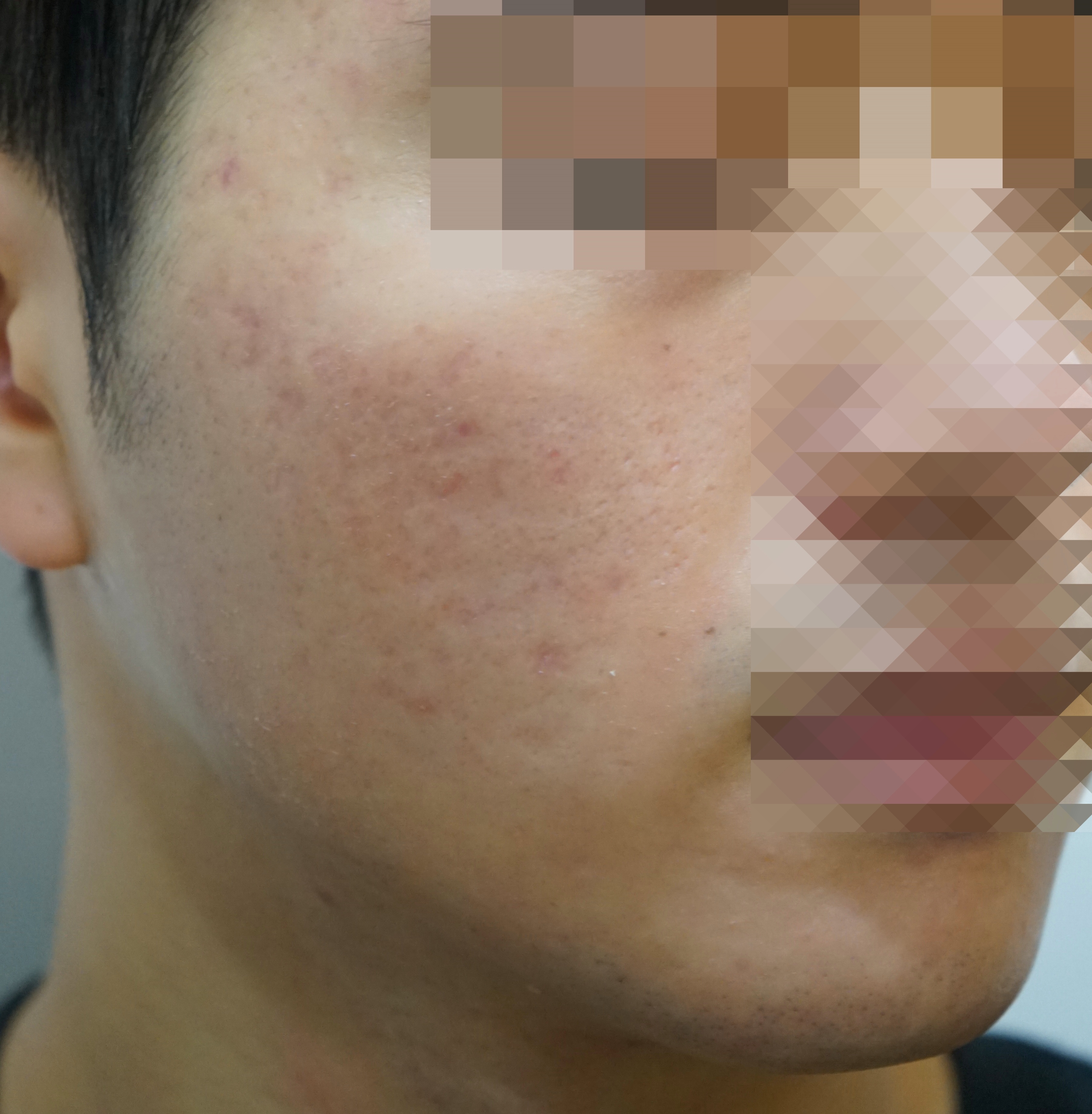 여드름 흉터 치료 경과 사례 사진