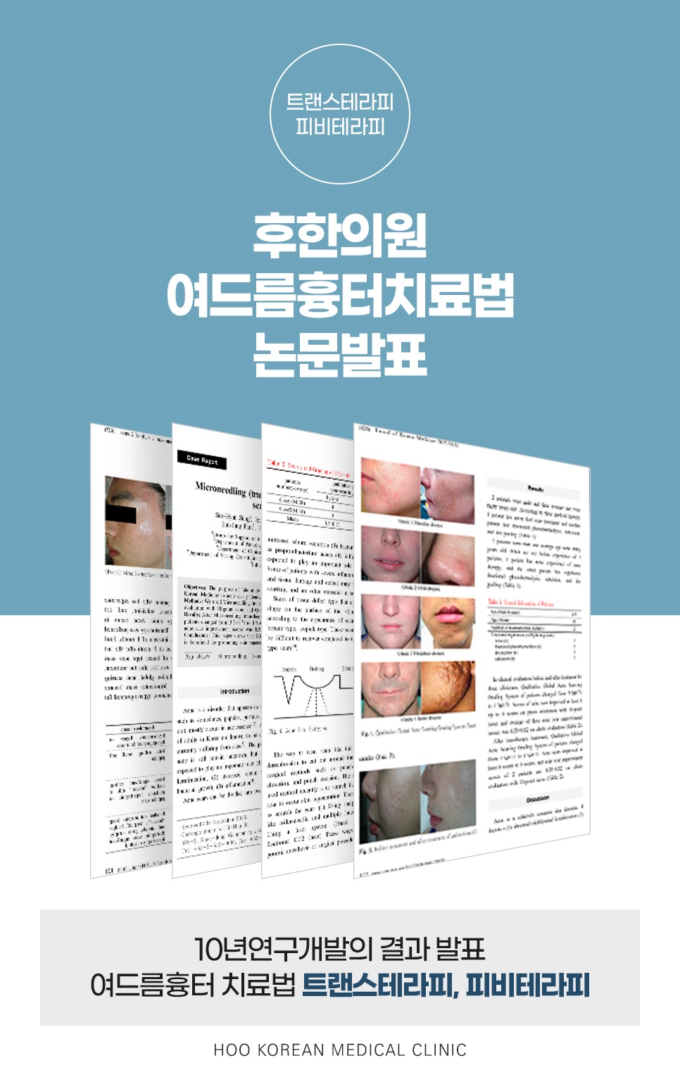 여드름 흉터 치료법(트랜스테라피, 피비테라피) 학술 논문 발표 자료