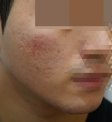 여드름 흉터 및 붉은 자국이 남아있는 치료 전 볼 피부 상태 사례 사진