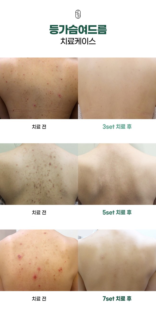 등여드름 치료전후