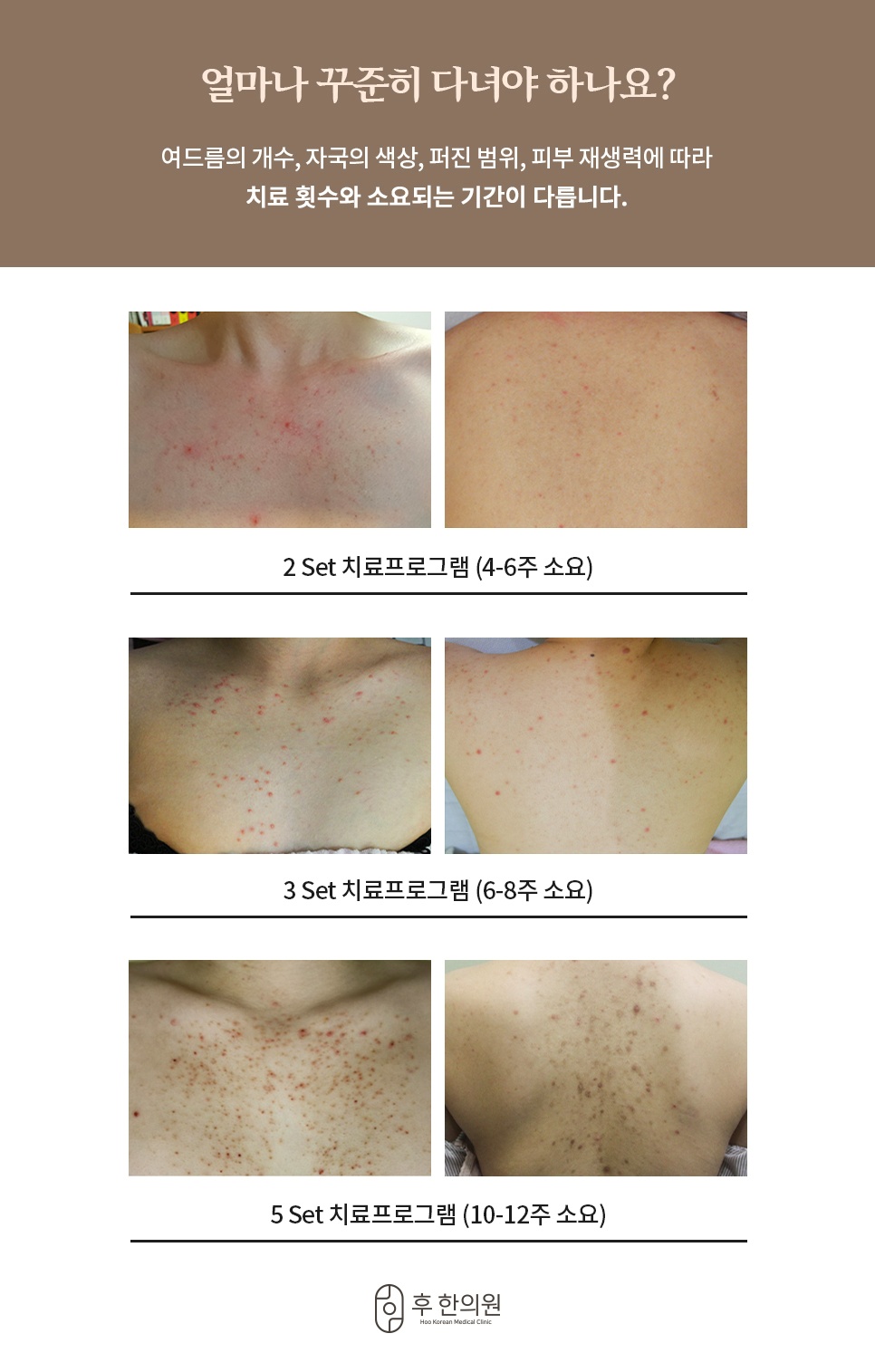 등가슴여드름 증상별 치료 기간 및 세트 프로그램