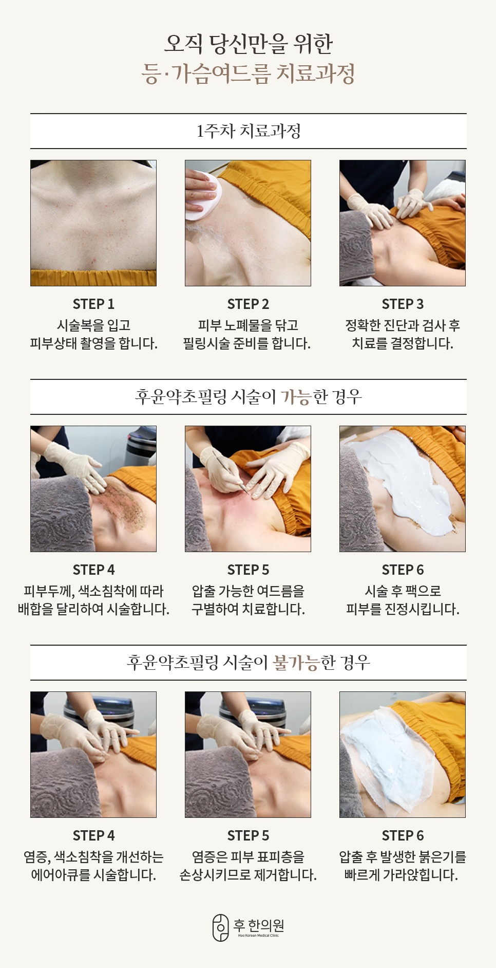 등가슴여드름 1주차 치료 및 필링 시술 과정