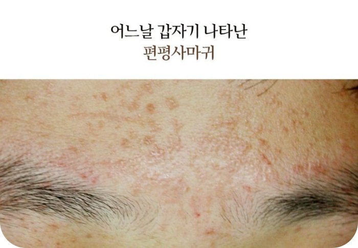 신림편평사마귀 제거 전 이마에 발생한 편평사마귀