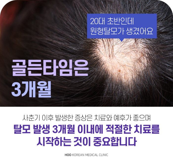 빗질 후 빠진 머리카락, 원형탈모 자연 회복과 재발 가능성 설명