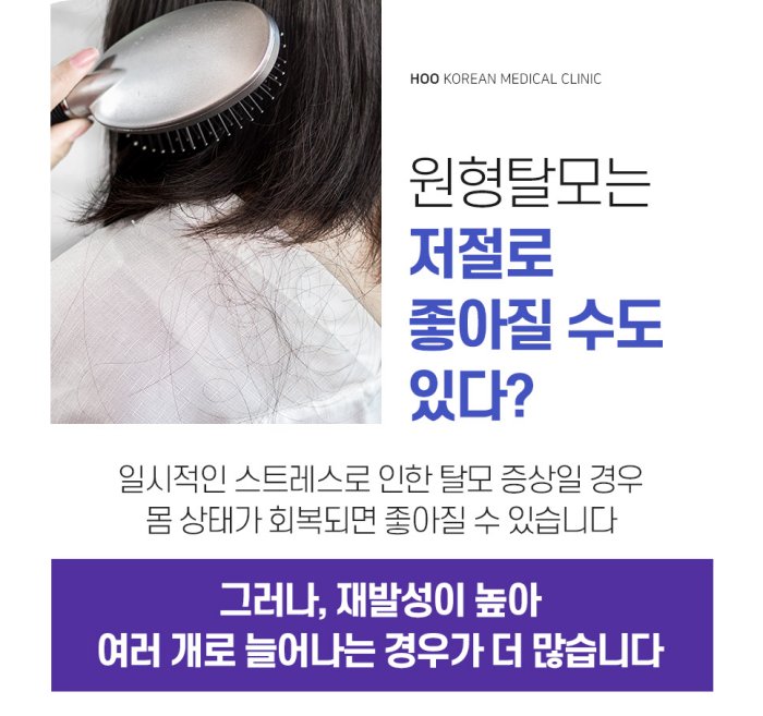  20대 원형탈모 탈모반 사진, 발생 3개월 이내 치료 시작이 중요하다는 안내