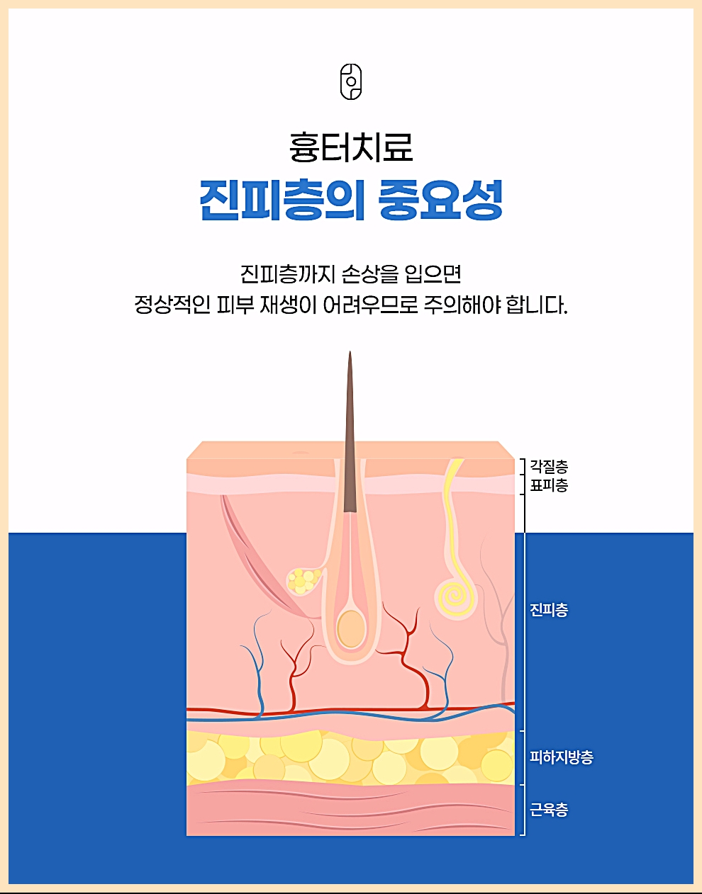 신림여드름흉터치료 진피층 손상되면 피부 재생이 어려운 이유를 설명