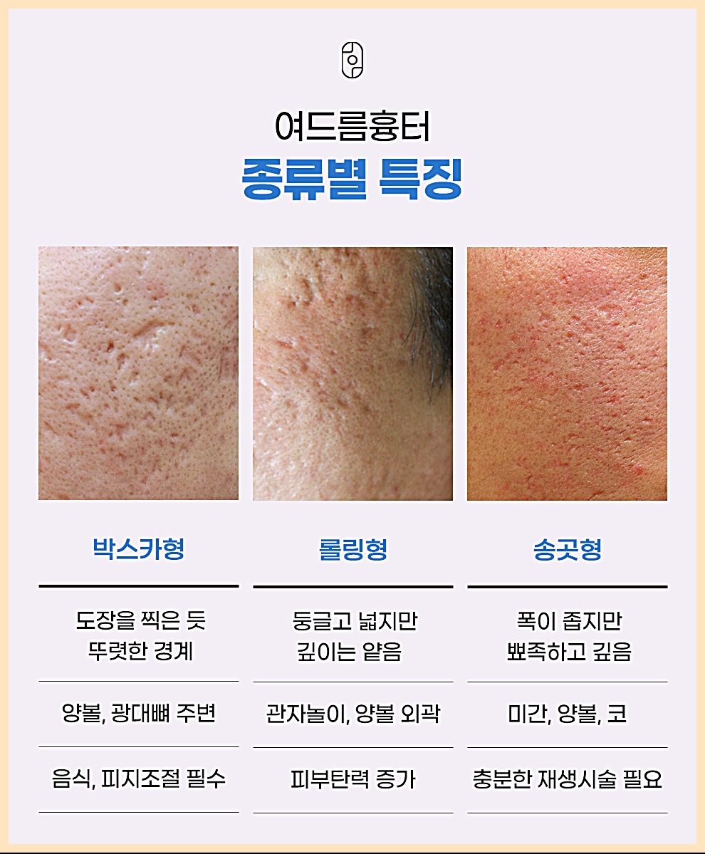 신림여드름흉터치료 박스카형, 롤링형, 송곳형 여드름 흉터 종류별 특징