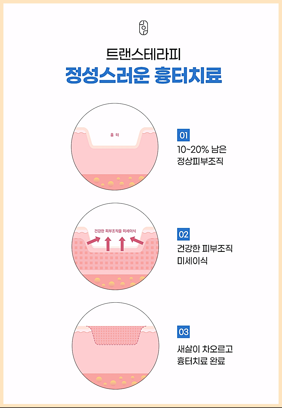 트랜스테라피(새살침)로 흉터 부위에 건강한 피부조직을 미세이식해 새살이 차오르는 과정