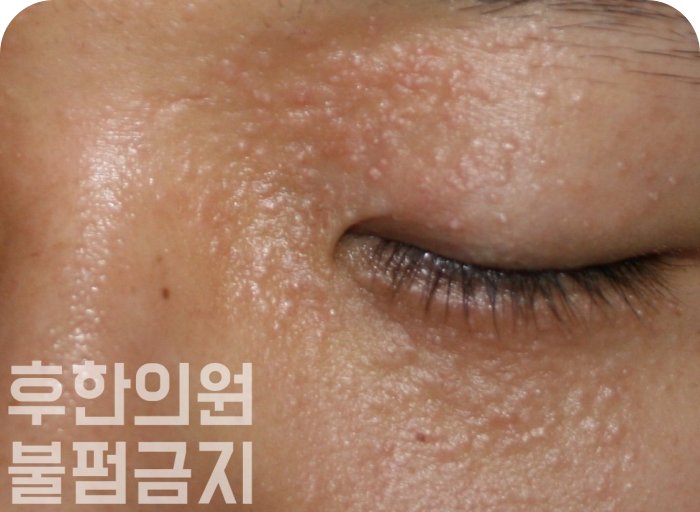 눈 주변 한관종 