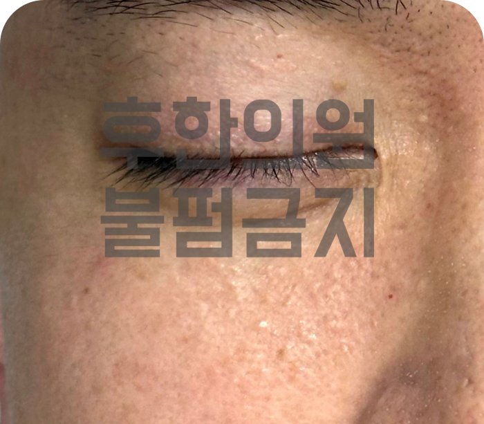 신림 한관종 치료전 