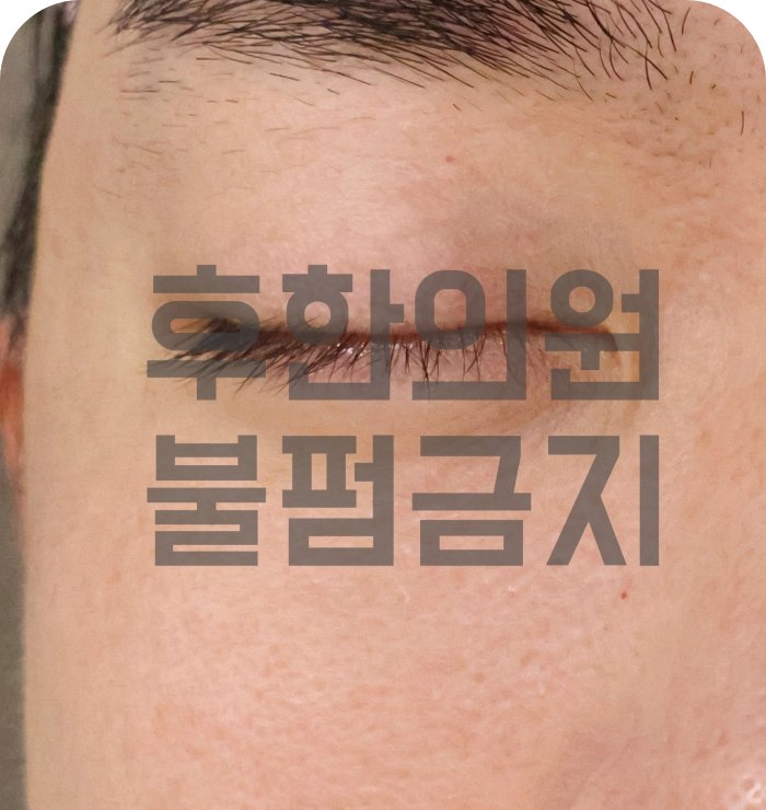 신림한관종 치료 후