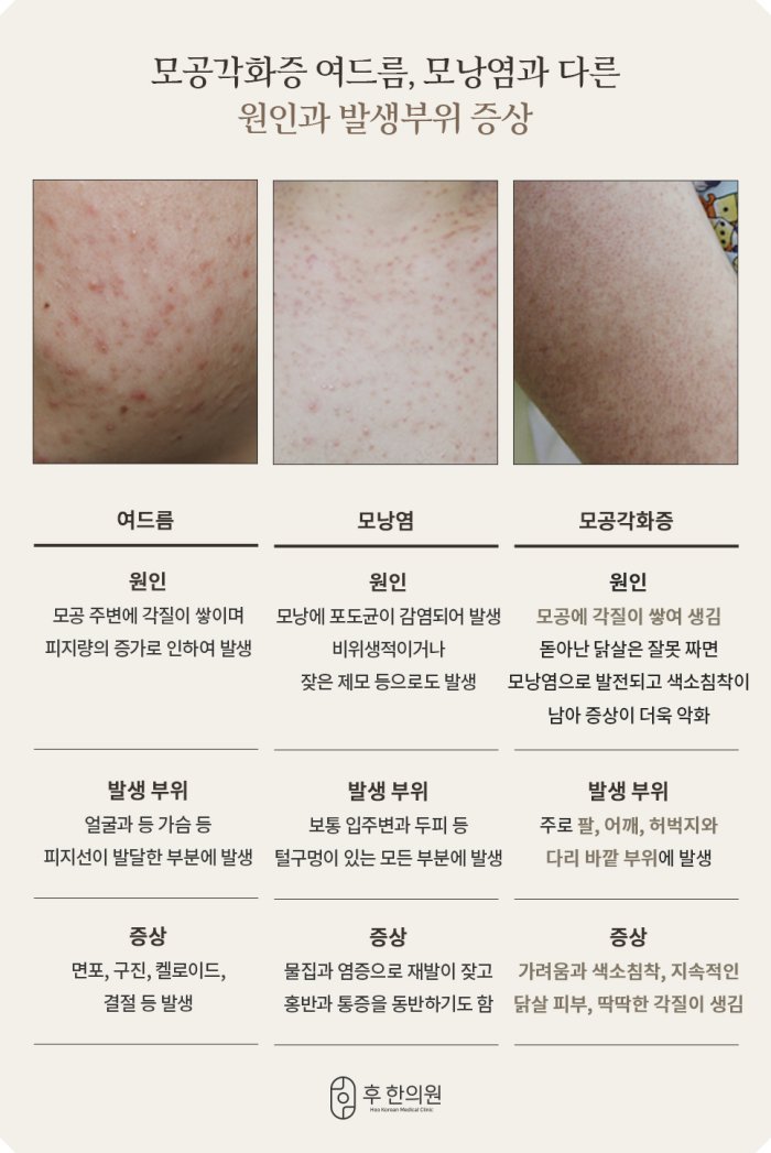 여드름, 모낭염, 모공각화증의 원인·발생 부위·증상 비교표