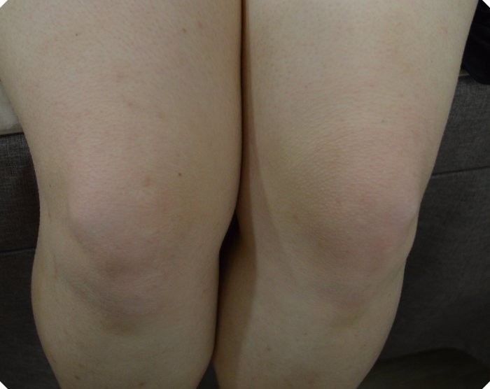 모공각화증 치료 후 매끄러워진 무릎과 허벅지 피부