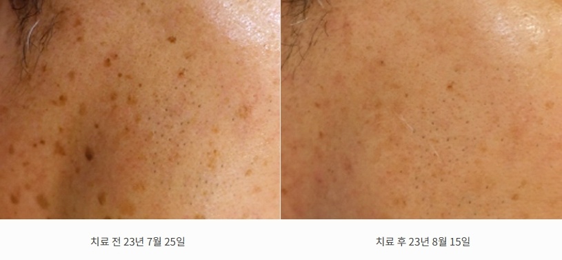 23년 7월 25일 볼 위 갈색 반점이 8월 15일 크게 옅어진 3주 전후 비교