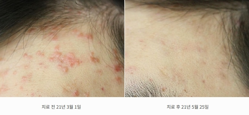 21년 3월 1일 이마 위쪽 붉은 구진이 5월 25일 눈에 띄게 줄어든 전후 사진