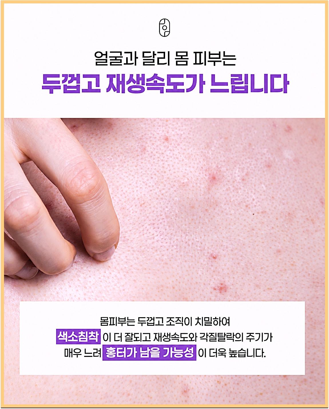 신림등드름 치료 얼굴과 달리 재생속도가 느린 몸 피부와 등여드름 부위